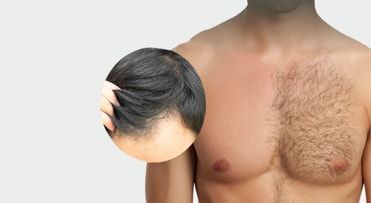 کاشت مو به روش BHT چیست؟